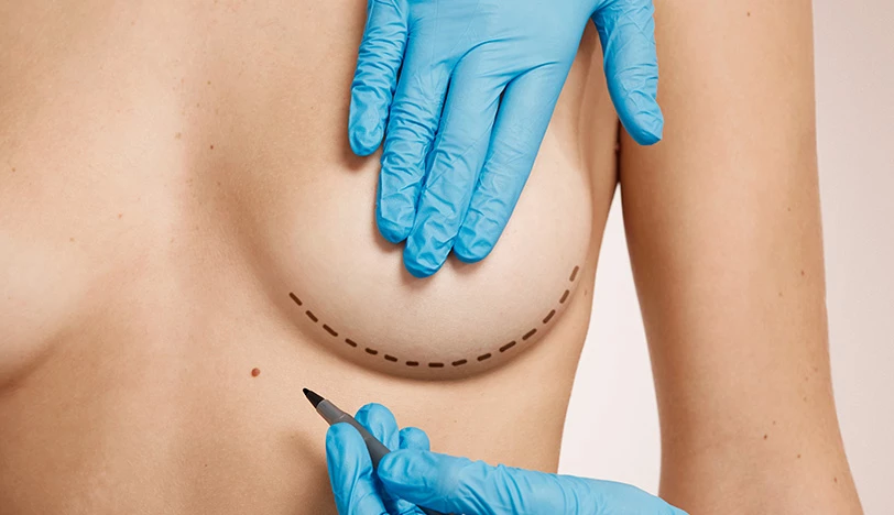 Hirurgija dojke